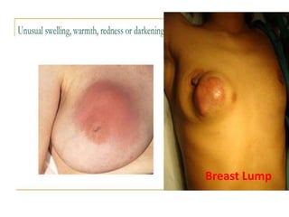 Breast Lump
 