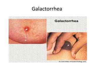 Galactorrhea
 
