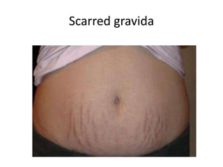 Scarred gravida
 