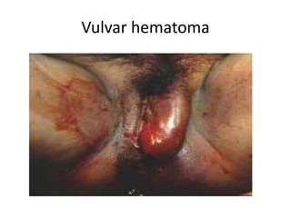 Vulvar hematoma
 