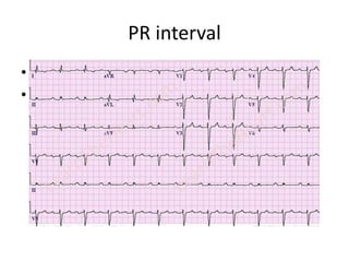 PR interval
• 0.12 – 0.20 ms
• Represents the time taken to depolarise the
atria and traverse the atrioventricular node.
 