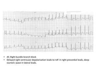 • AF, Right bundle branch block
• Delayed right ventricular depolarisation leads to rsR’ in right precordial leads, deep
slurred s wave in lateral leads.
 