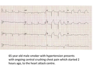 65 year old male smoker with hypertension presents
with ongoing central crushing chest pain which started 2
hours ago, to the heart attack centre.
 