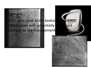 • ECGs give rapid at the bedside diagnostic
information with potentially significant
changes to the management
 