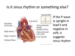Is it sinus rhythm or something else?
If the P wave
is upright in
lead II and
negative in
aVR, it
suggests
sinus rhythm
 