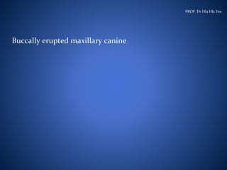 Buccally erupted maxillary canine
PROF Dr Hla Hla Yee
 