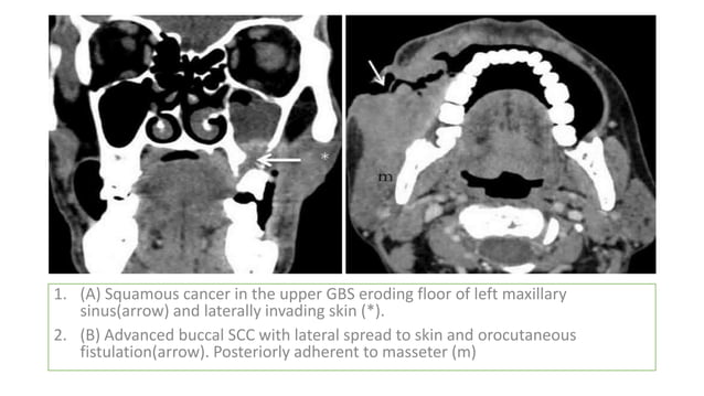 Normal Anatomy of Buccal mucosa and cancer | PPTX | Dental Health ...