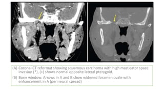 Normal Anatomy of Buccal mucosa and cancer | PPTX