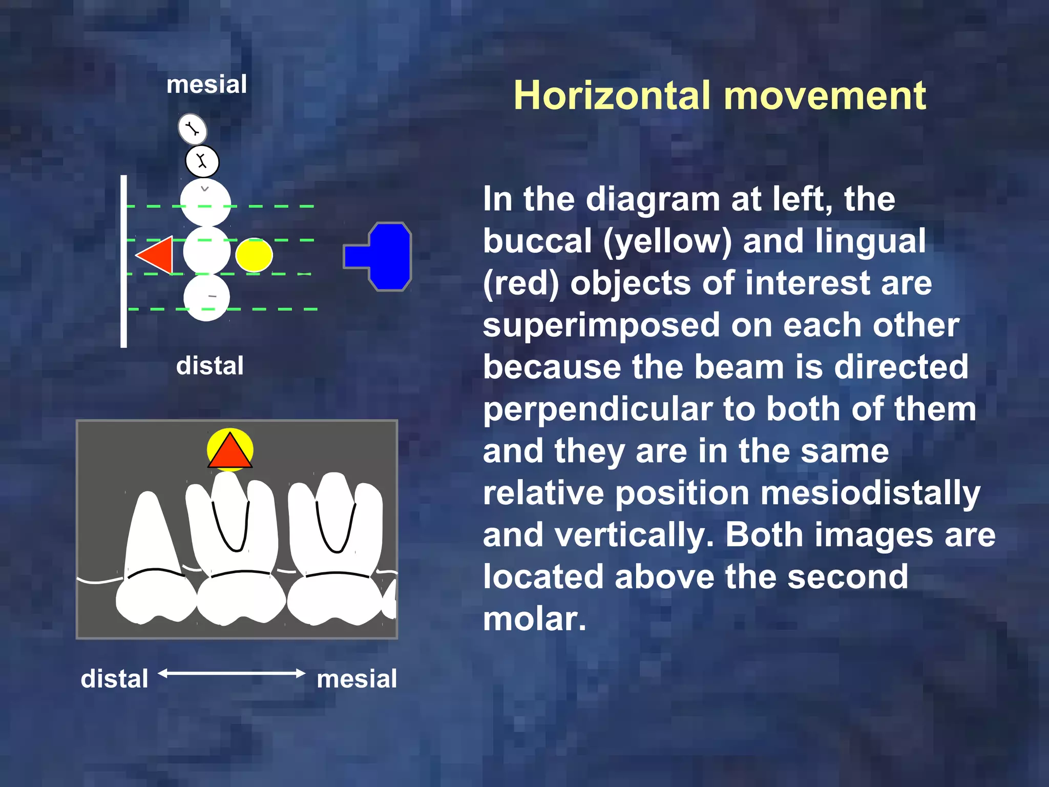 In the diagram at left, the
buccal (yellow) and lingual
(red) objects of interest are
superimposed on each other
because the beam is directed
perpendicular to both of them
and they are in the same
relative position mesiodistally
and vertically. Both images are
located above the second
molar.
mesial
distal
mesialdistal
Horizontal movement
 
