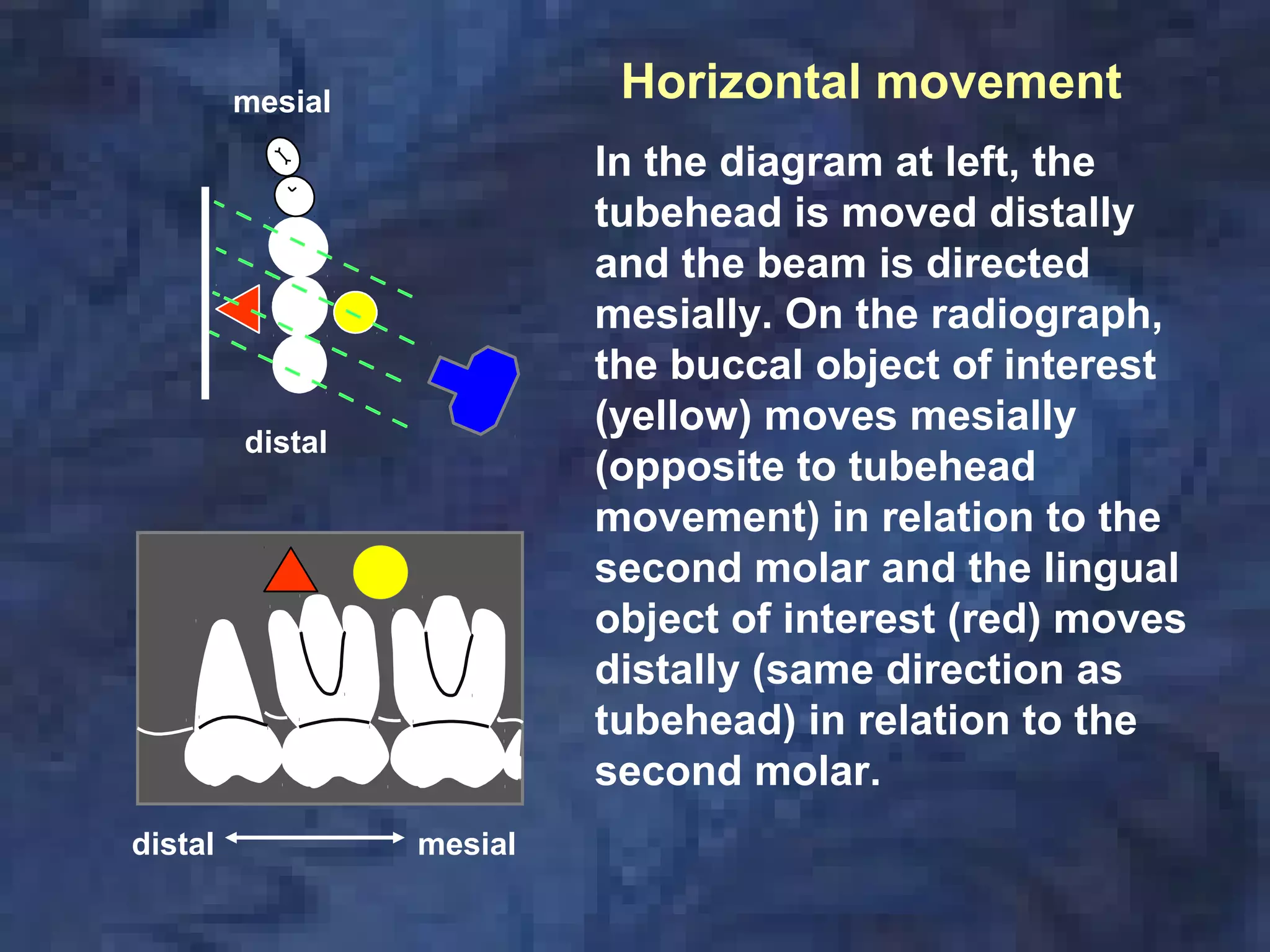 In the diagram at left, the
tubehead is moved distally
and the beam is directed
mesially. On the radiograph,
the buccal object of interest
(yellow) moves mesially
(opposite to tubehead
movement) in relation to the
second molar and the lingual
object of interest (red) moves
distally (same direction as
tubehead) in relation to the
second molar.
mesialdistal
mesial
distal
Horizontal movement
 