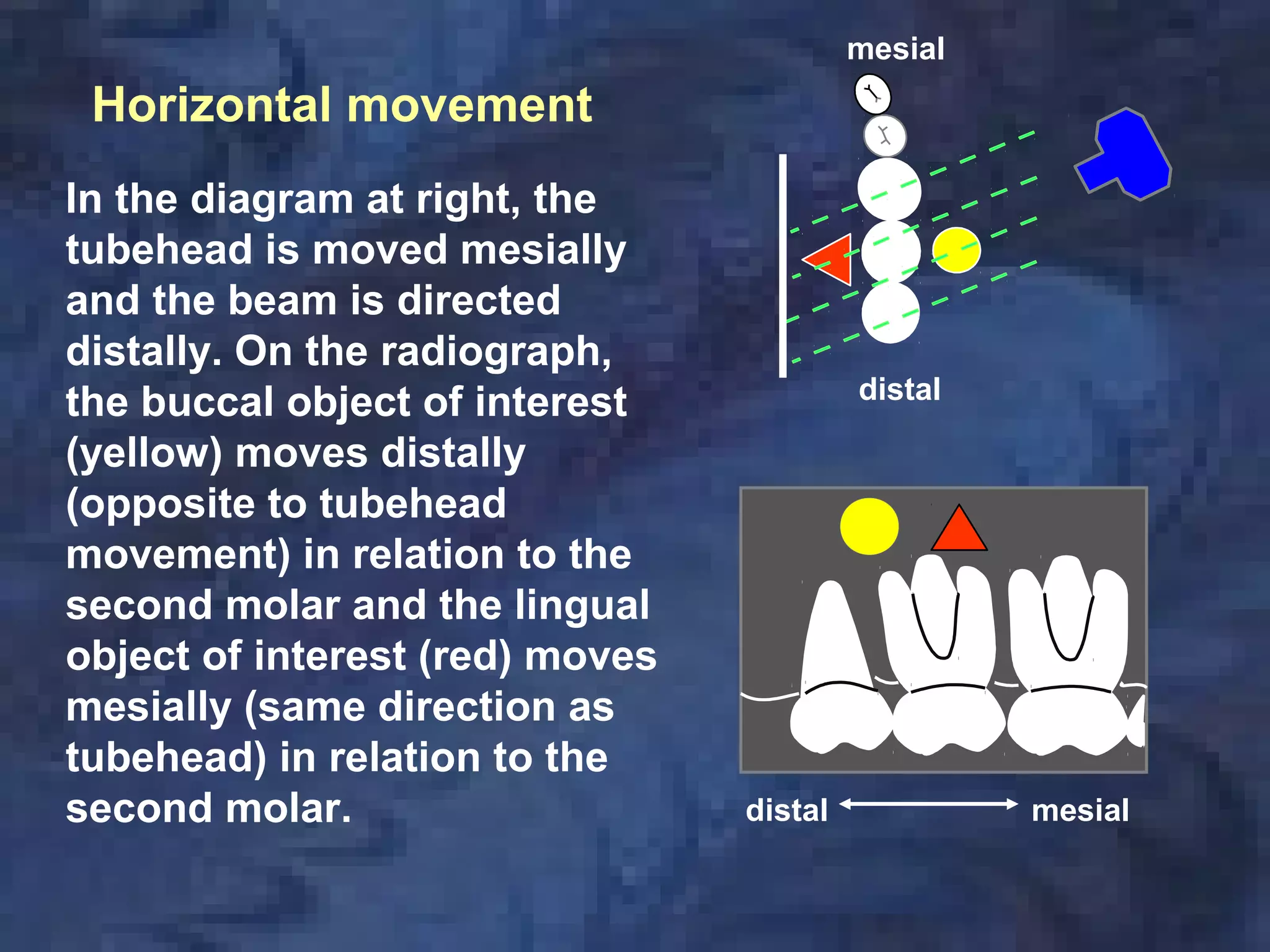 In the diagram at right, the
tubehead is moved mesially
and the beam is directed
distally. On the radiograph,
the buccal object of interest
(yellow) moves distally
(opposite to tubehead
movement) in relation to the
second molar and the lingual
object of interest (red) moves
mesially (same direction as
tubehead) in relation to the
second molar.
mesial
distal
mesialdistal
Horizontal movement
 