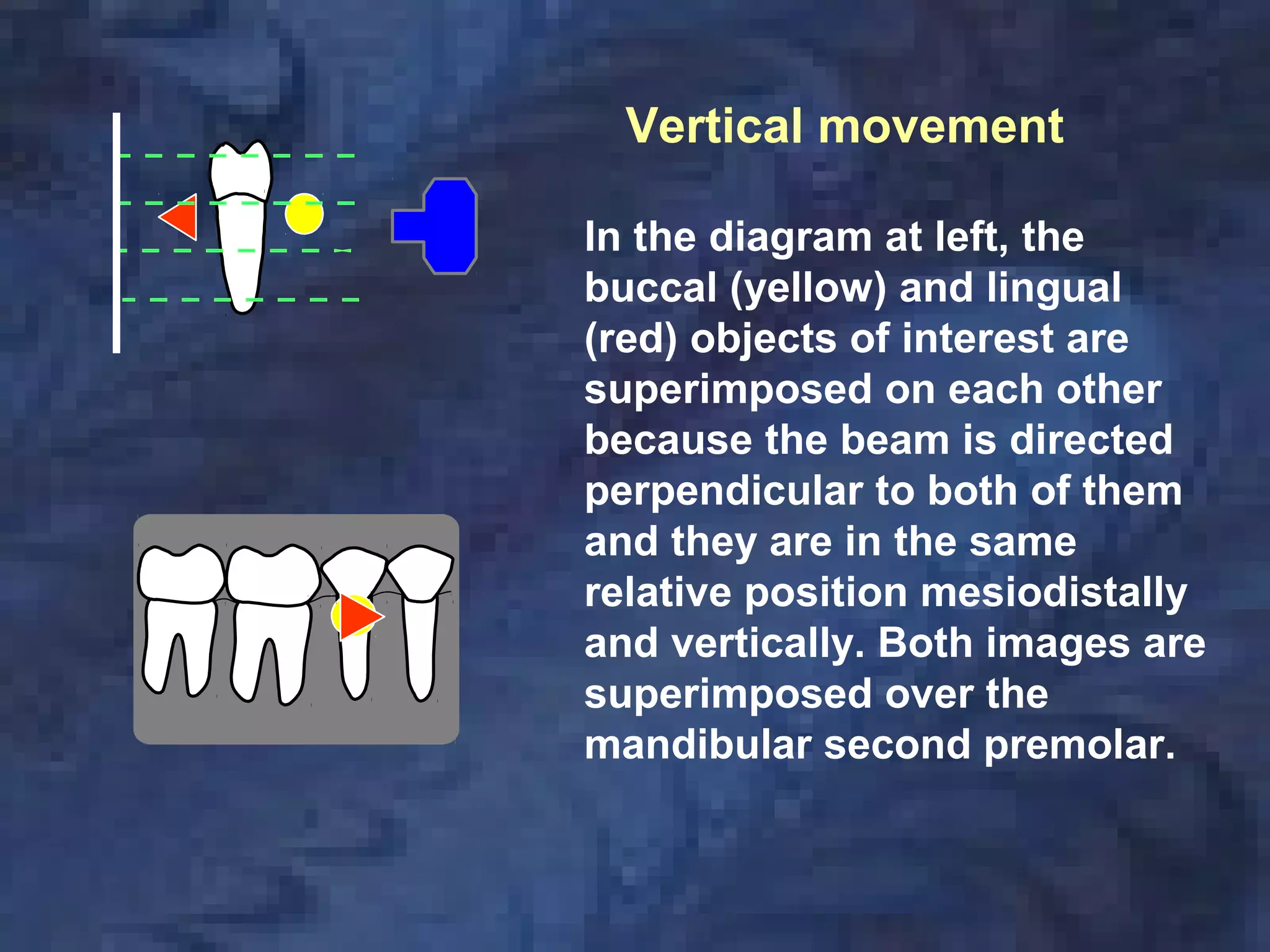 In the diagram at left, the
buccal (yellow) and lingual
(red) objects of interest are
superimposed on each other
because the beam is directed
perpendicular to both of them
and they are in the same
relative position mesiodistally
and vertically. Both images are
superimposed over the
mandibular second premolar.
Vertical movement
 