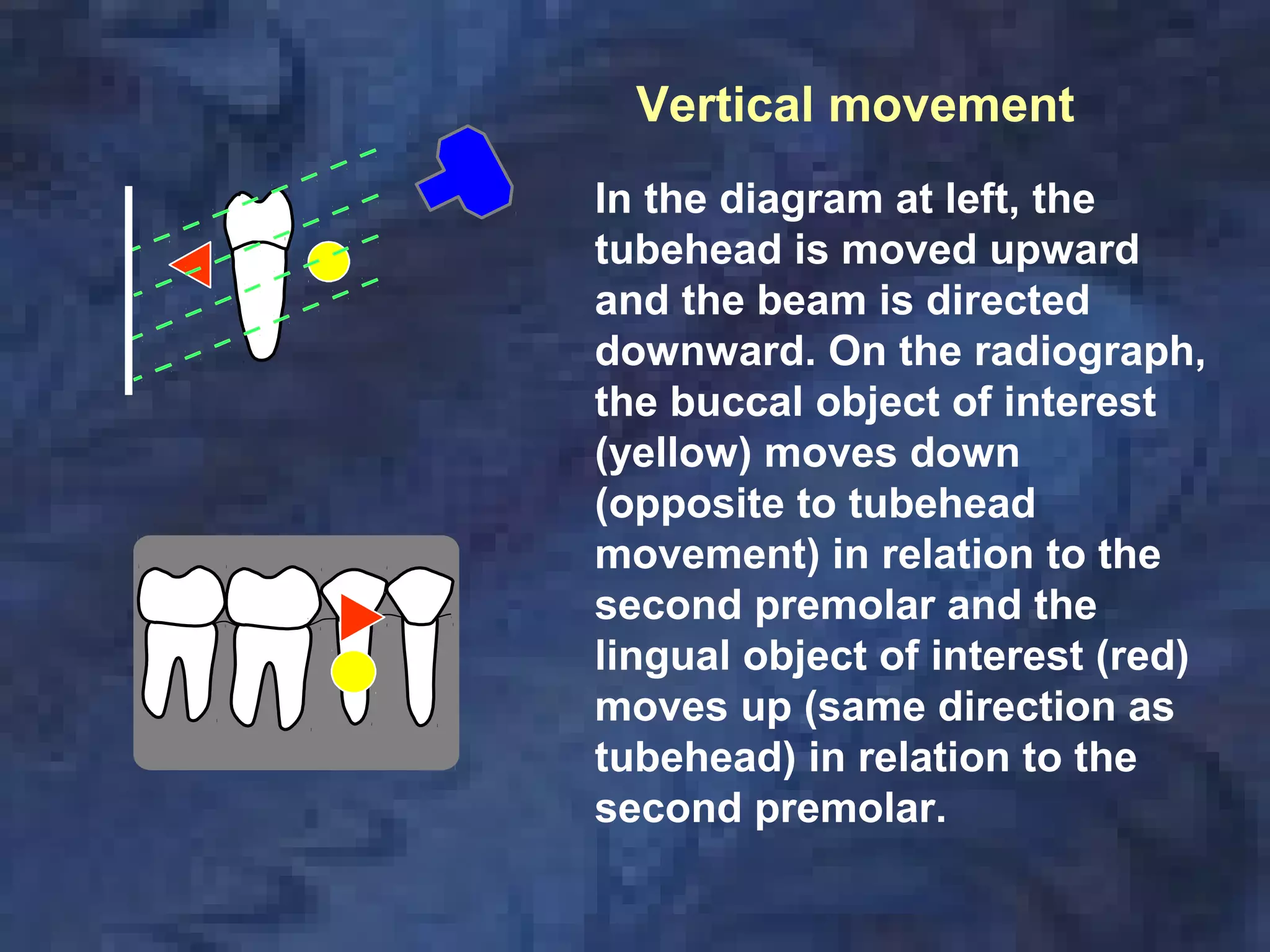 In the diagram at left, the
tubehead is moved upward
and the beam is directed
downward. On the radiograph,
the buccal object of interest
(yellow) moves down
(opposite to tubehead
movement) in relation to the
second premolar and the
lingual object of interest (red)
moves up (same direction as
tubehead) in relation to the
second premolar.
Vertical movement
 
