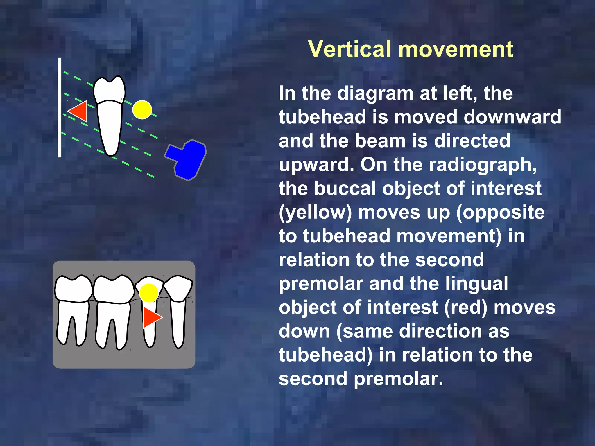In the diagram at left, the
tubehead is moved downward
and the beam is directed
upward. On the radiograph,
the buccal object of interest
(yellow) moves up (opposite
to tubehead movement) in
relation to the second
premolar and the lingual
object of interest (red) moves
down (same direction as
tubehead) in relation to the
second premolar.
Vertical movement
 