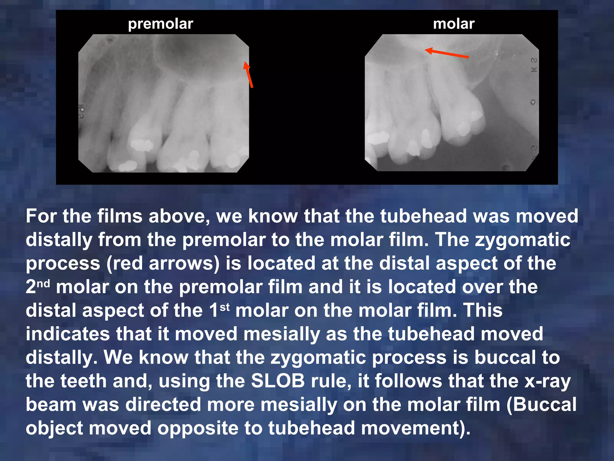 For the films above, we know that the tubehead was moved
distally from the premolar to the molar film. The zygomatic
process (red arrows) is located at the distal aspect of the
2nd
molar on the premolar film and it is located over the
distal aspect of the 1st
molar on the molar film. This
indicates that it moved mesially as the tubehead moved
distally. We know that the zygomatic process is buccal to
the teeth and, using the SLOB rule, it follows that the x-ray
beam was directed more mesially on the molar film (Buccal
object moved opposite to tubehead movement).
premolar molar
 