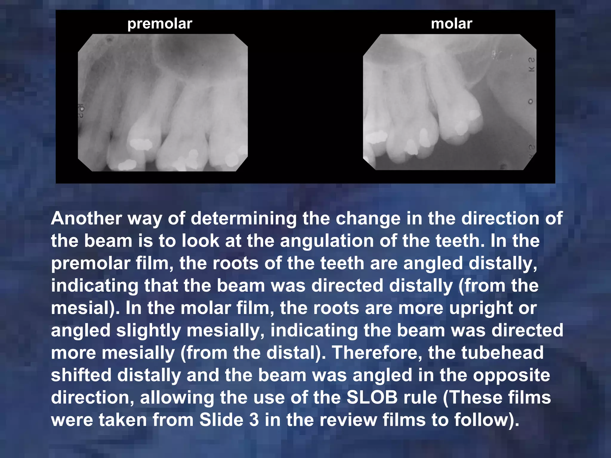 premolar molar
Another way of determining the change in the direction of
the beam is to look at the angulation of the teeth. In the
premolar film, the roots of the teeth are angled distally,
indicating that the beam was directed distally (from the
mesial). In the molar film, the roots are more upright or
angled slightly mesially, indicating the beam was directed
more mesially (from the distal). Therefore, the tubehead
shifted distally and the beam was angled in the opposite
direction, allowing the use of the SLOB rule (These films
were taken from Slide 3 in the review films to follow).
 