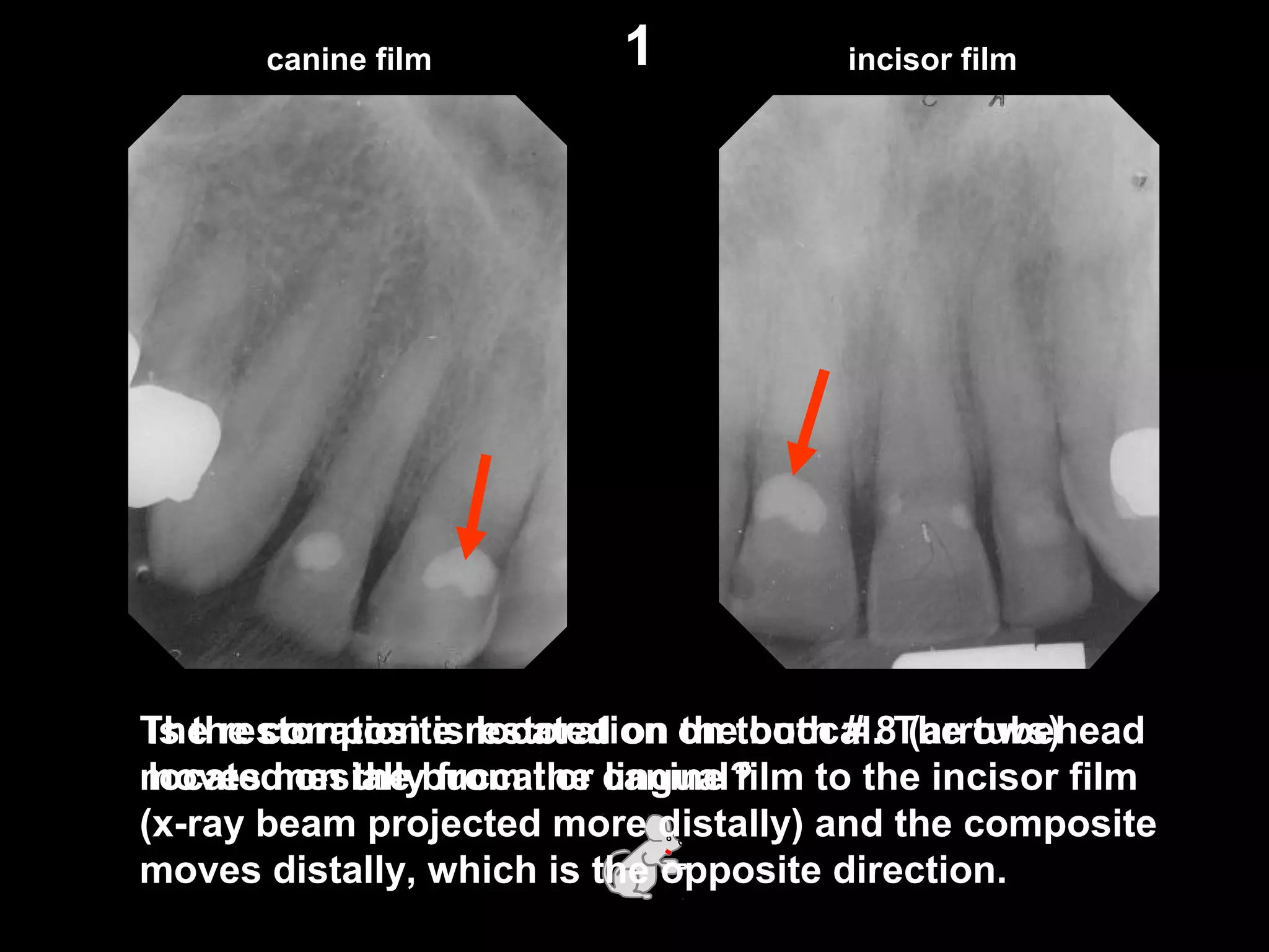 Is the composite restoration on tooth # 8 (arrows)
located on the buccal or lingual?
canine film incisor film1
The restoration is located on the buccal. The tubehead
moves mesially from the canine film to the incisor film
(x-ray beam projected more distally) and the composite
moves distally, which is the opposite direction.
 