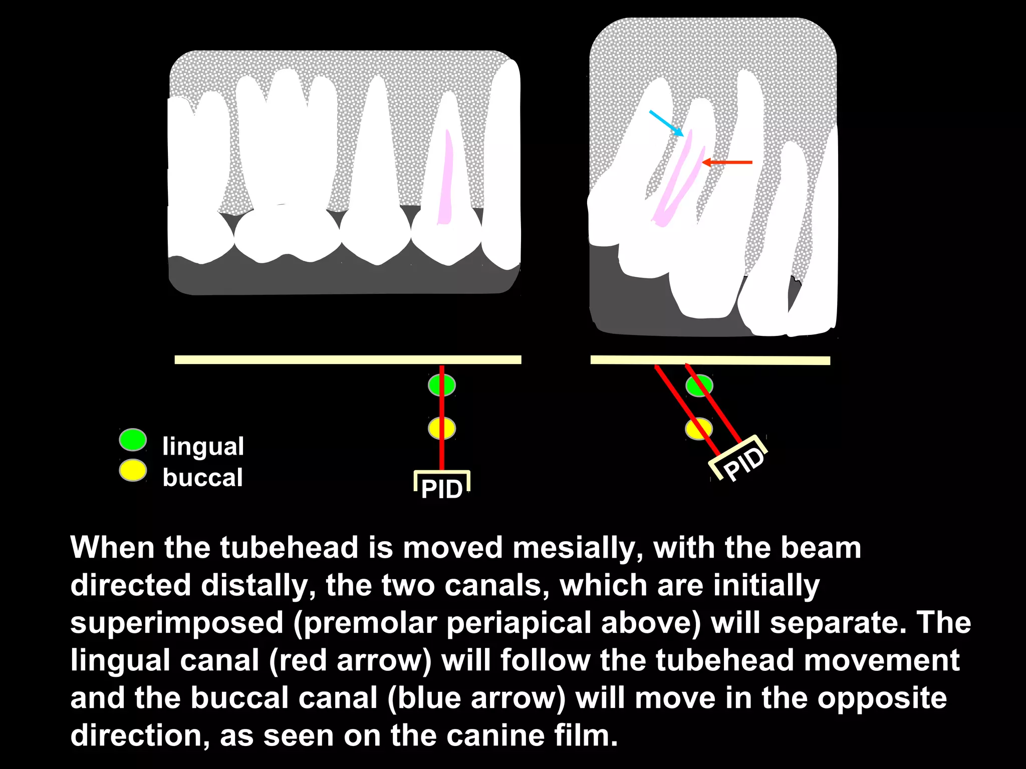 PID
PID
lingual
buccal
When the tubehead is moved mesially, with the beam
directed distally, the two canals, which are initially
superimposed (premolar periapical above) will separate. The
lingual canal (red arrow) will follow the tubehead movement
and the buccal canal (blue arrow) will move in the opposite
direction, as seen on the canine film.
 