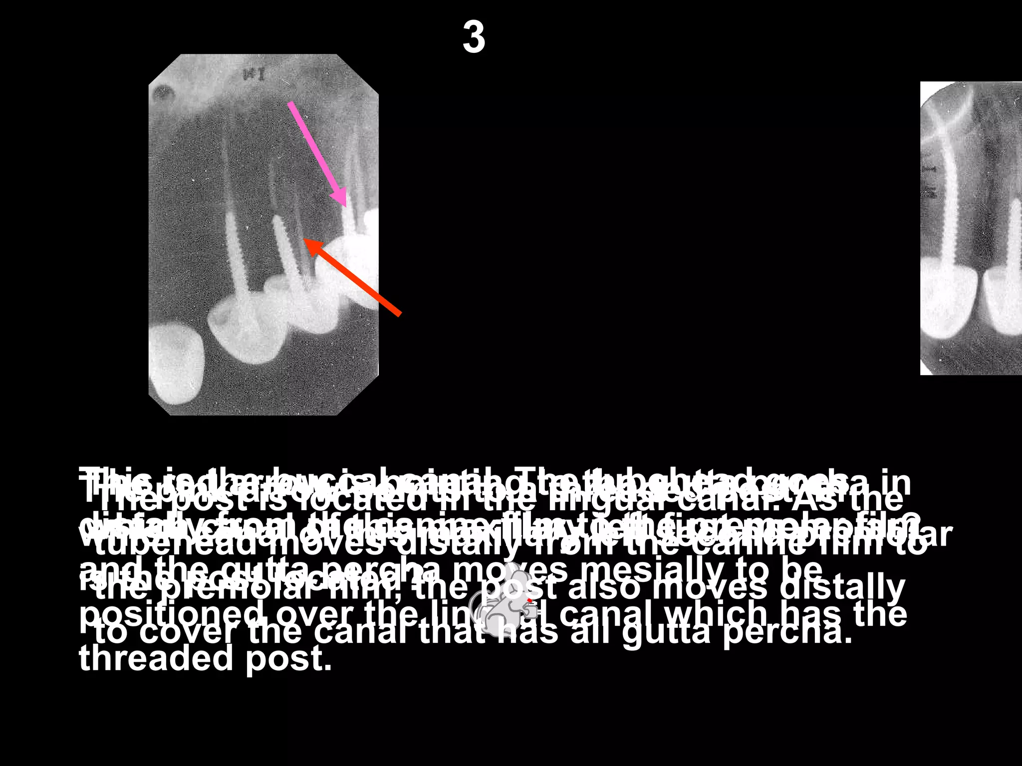 The red arrow is pointing to the gutta percha in
which canal of this maxillary left first premolar?
This is the buccal canal. The tubehead goes
distally from the canine film to the premolar film
and the gutta percha moves mesially to be
positioned over the lingual canal which has the
threaded post.
The pink arrow points to a threaded post. In
which canal of this maxillary left second premolar
is the post located?
The post is located in the lingual canal. As the
tubehead moves distally from the canine film to
the premolar film, the post also moves distally
to cover the canal that has all gutta percha.
3
 