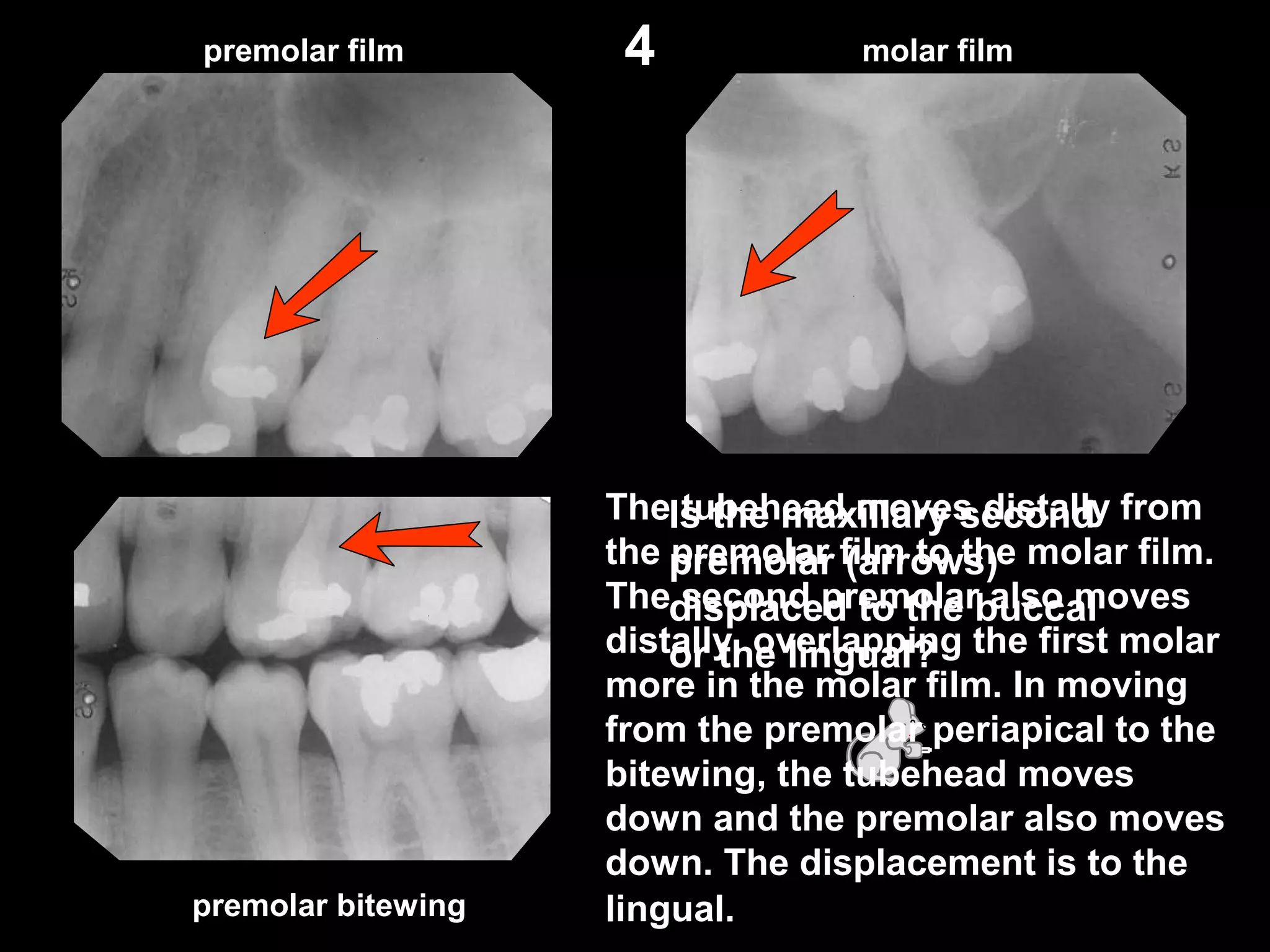 Is the maxillary second
premolar (arrows)
displaced to the buccal
or the lingual?
premolar film molar film
premolar bitewing
4
The tubehead moves distally from
the premolar film to the molar film.
The second premolar also moves
distally, overlapping the first molar
more in the molar film. In moving
from the premolar periapical to the
bitewing, the tubehead moves
down and the premolar also moves
down. The displacement is to the
lingual.
 