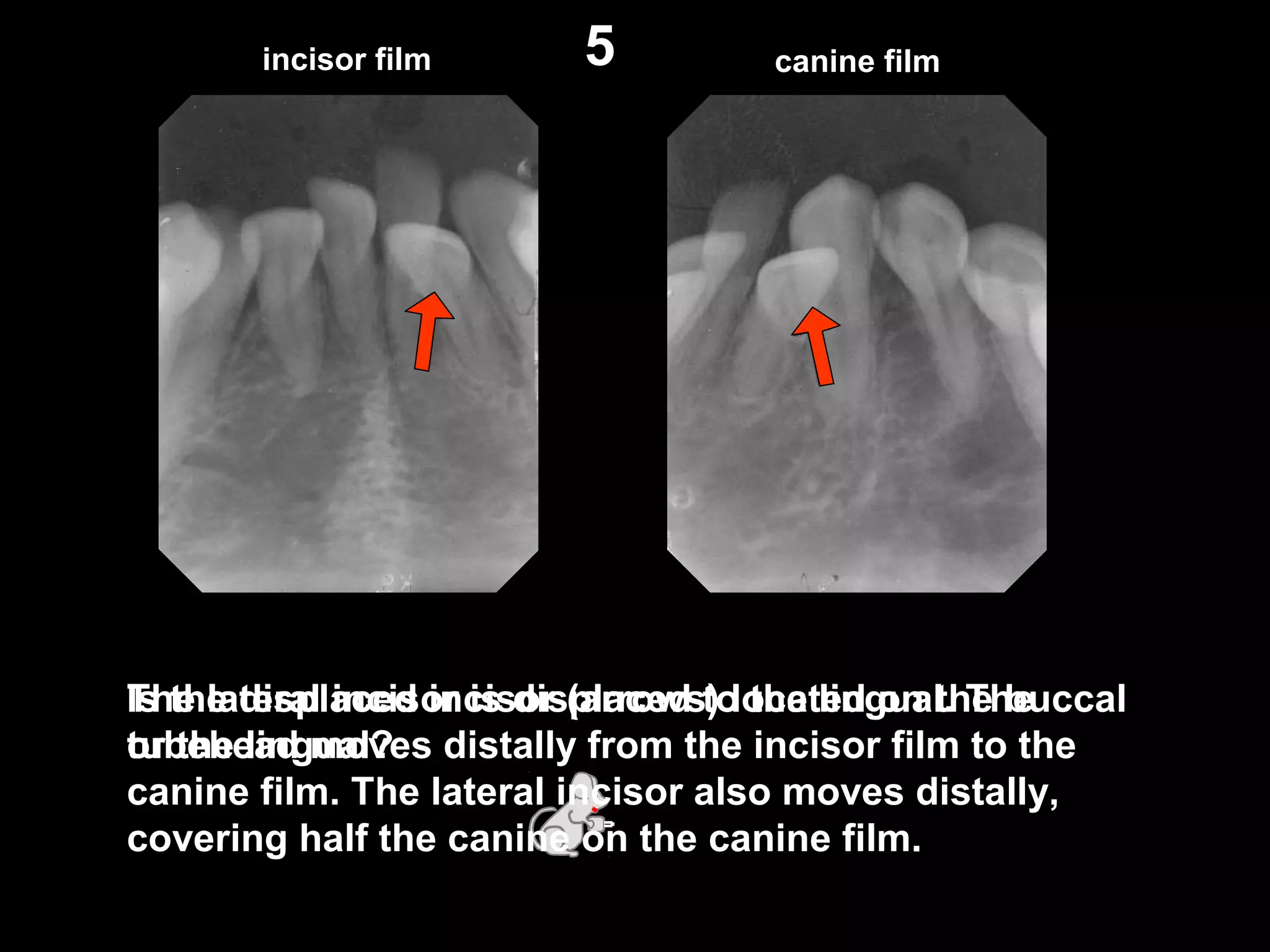 incisor film canine film
Is the displaced incisor (arrows) located on the buccal
or the lingual?
5
The lateral incisor is displaced to the lingual. The
tubehead moves distally from the incisor film to the
canine film. The lateral incisor also moves distally,
covering half the canine on the canine film.
 