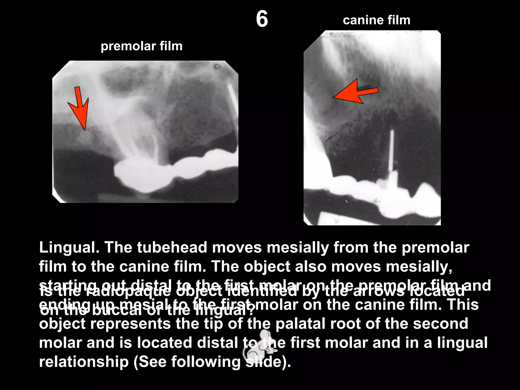 canine film
premolar film
Is the radiopaque object identified by the arrows located
on the buccal or the lingual?
6
Lingual. The tubehead moves mesially from the premolar
film to the canine film. The object also moves mesially,
starting out distal to the first molar on the premolar film and
ending up mesial to the first molar on the canine film. This
object represents the tip of the palatal root of the second
molar and is located distal to the first molar and in a lingual
relationship (See following slide).
 