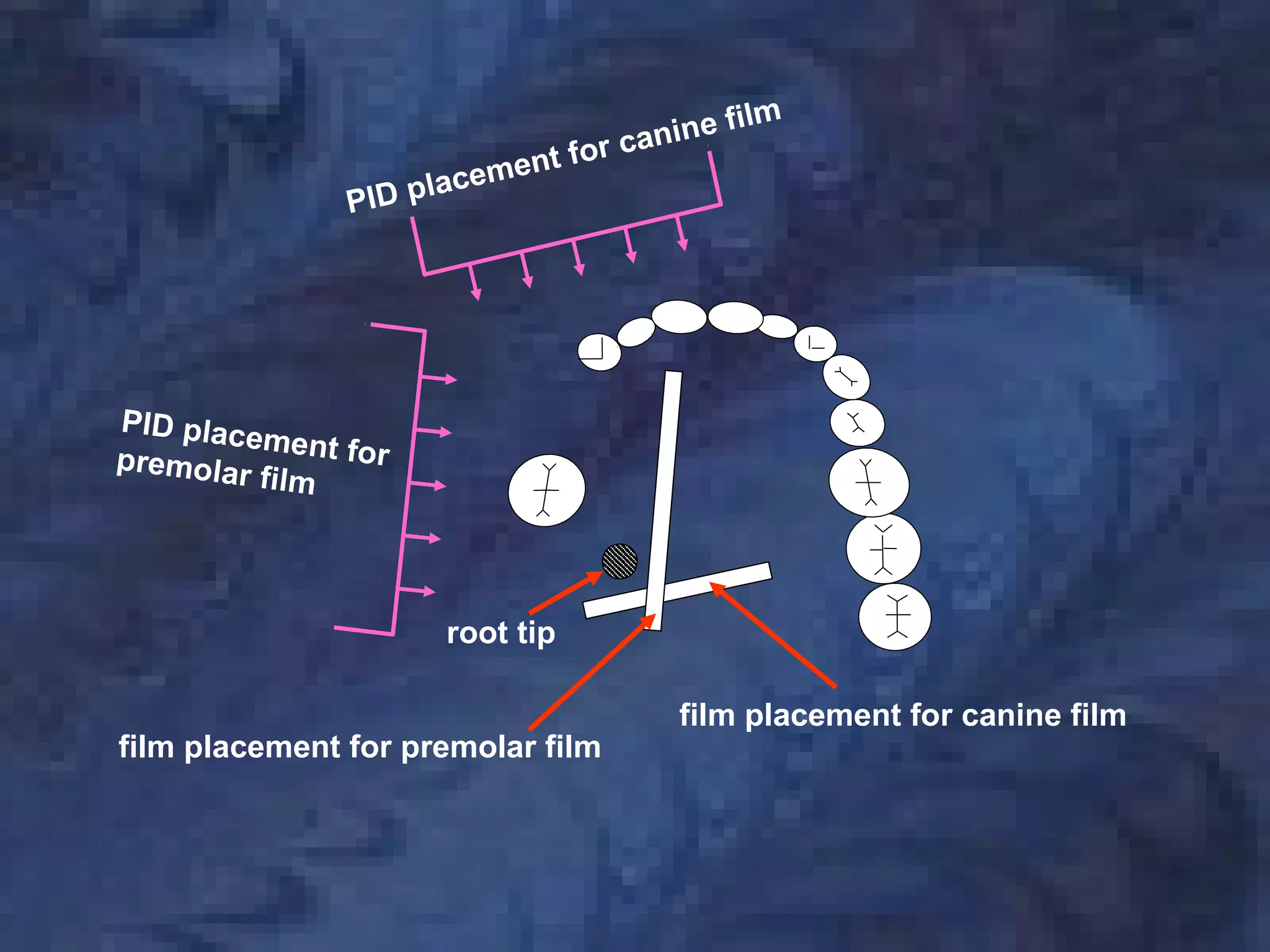 film placement for canine film
film placement for premolar film
PID placement forpremolar film
PID placement for canine film
root tip
 