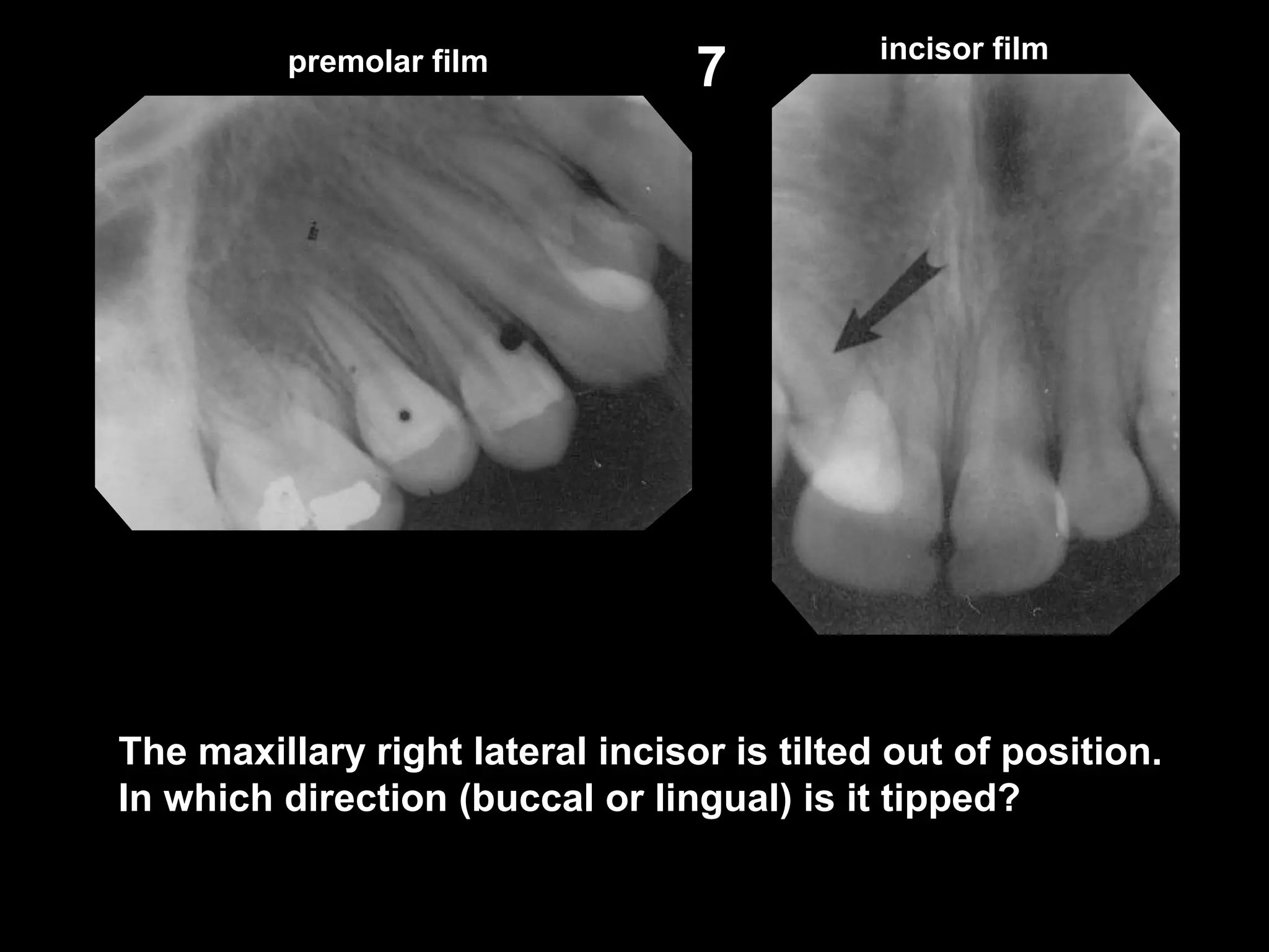 7
The maxillary right lateral incisor is tilted out of position.
In which direction (buccal or lingual) is it tipped?
premolar film incisor film
 