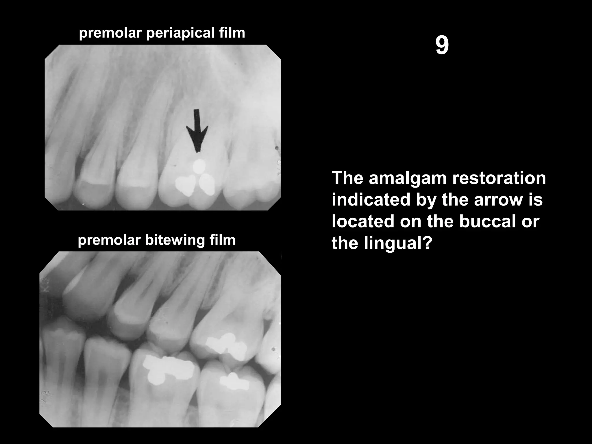 premolar bitewing film
9
The amalgam restoration
indicated by the arrow is
located on the buccal or
the lingual?
premolar periapical film
 