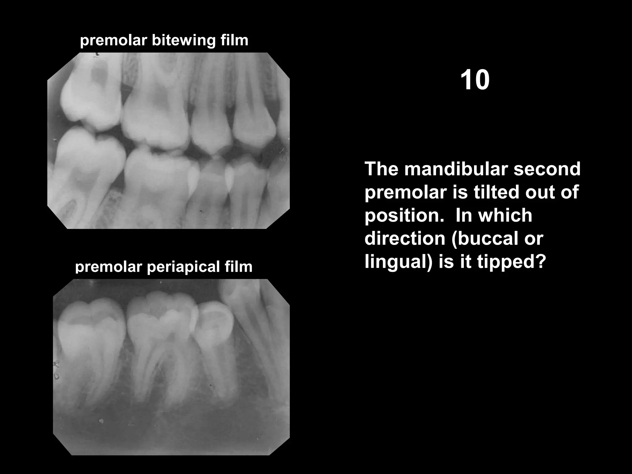 premolar periapical film
premolar bitewing film
10
The mandibular second
premolar is tilted out of
position. In which
direction (buccal or
lingual) is it tipped?
 