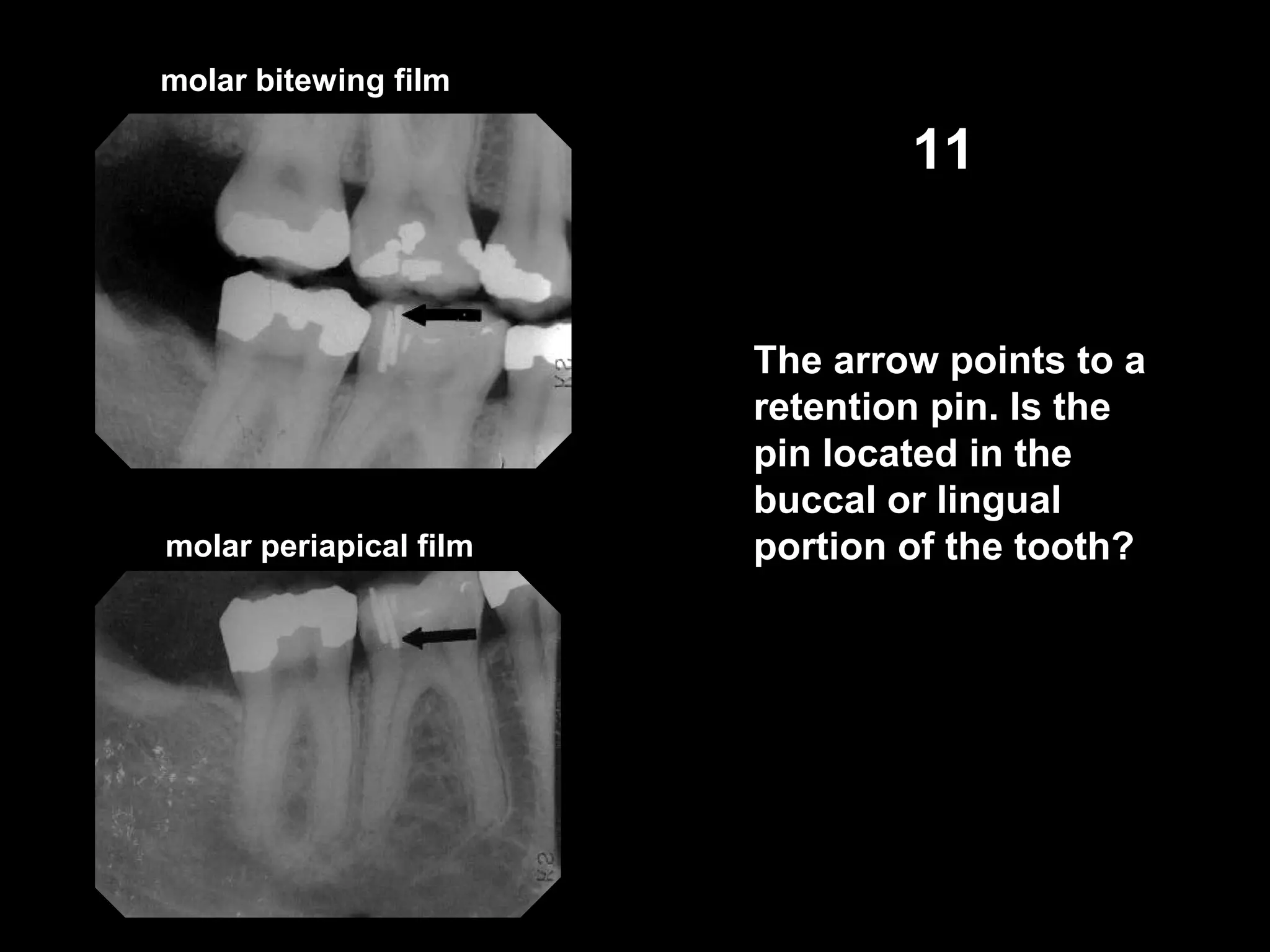 molar bitewing film
molar periapical film
11
The arrow points to a
retention pin. Is the
pin located in the
buccal or lingual
portion of the tooth?
 