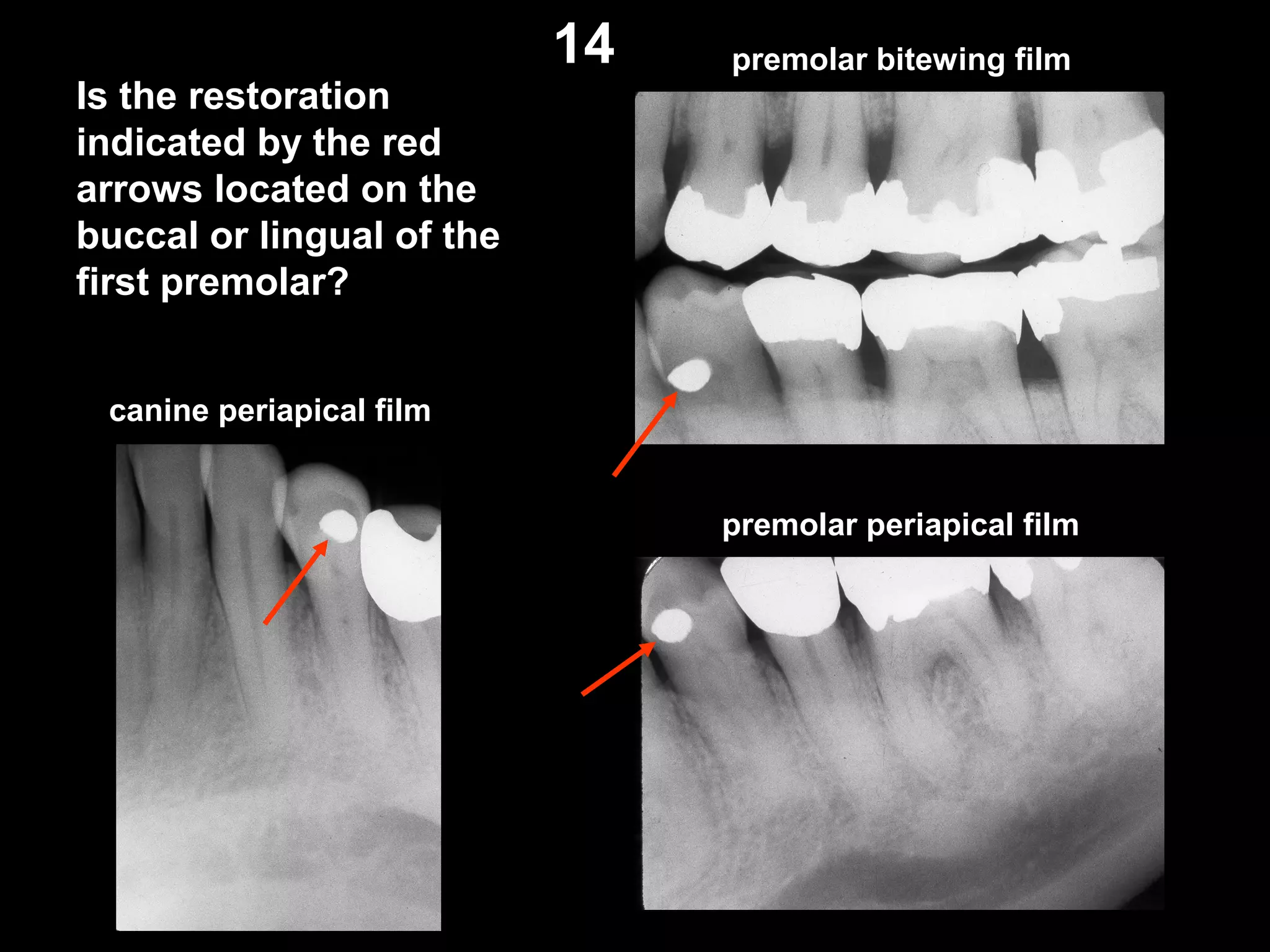 Is the restoration
indicated by the red
arrows located on the
buccal or lingual of the
first premolar?
canine periapical film
premolar periapical film
premolar bitewing film14
 
