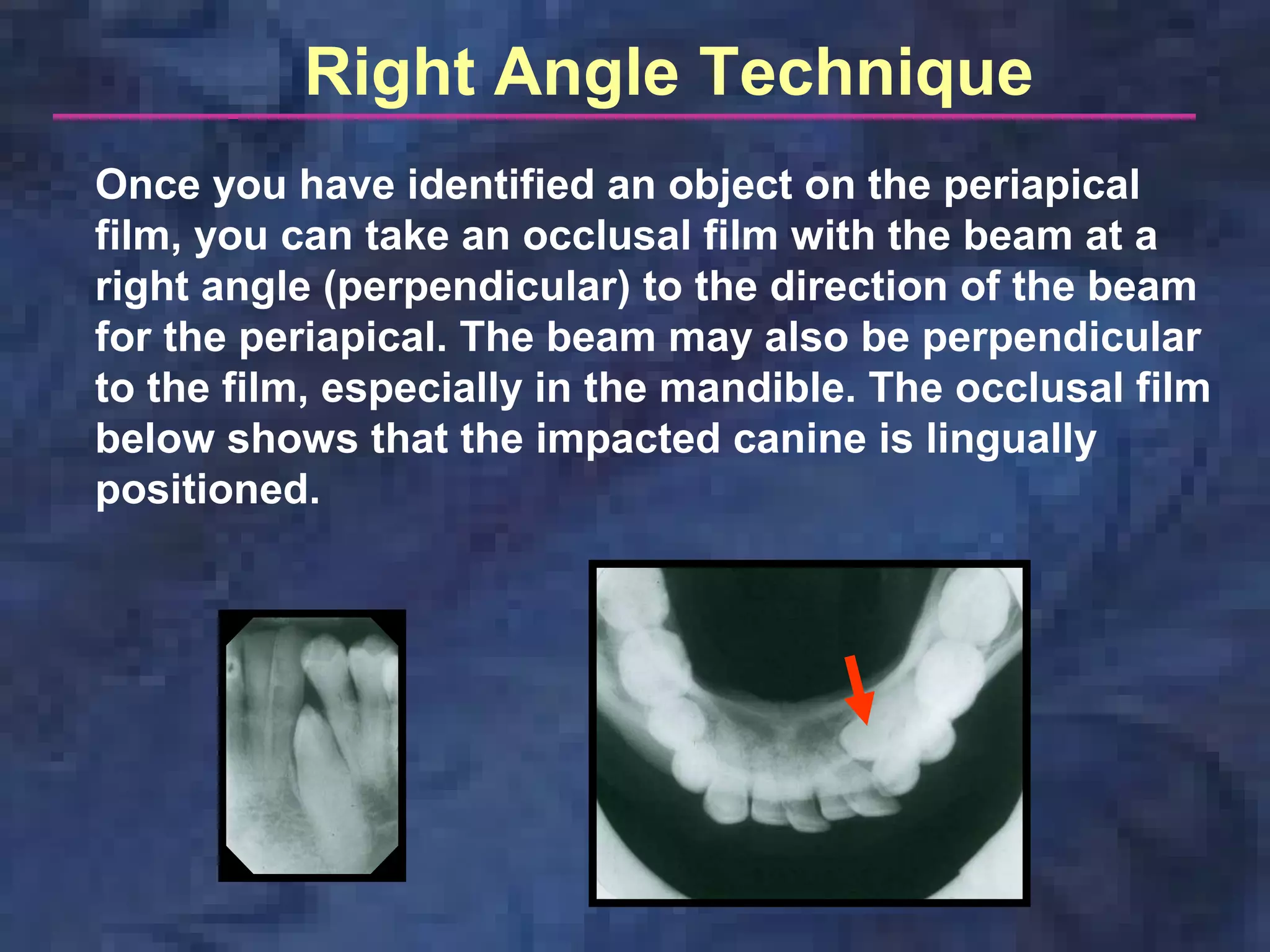 Right Angle (Occlusal) technique
Right Angle Technique
Once you have identified an object on the periapical
film, you can take an occlusal film with the beam at a
right angle (perpendicular) to the direction of the beam
for the periapical. The beam may also be perpendicular
to the film, especially in the mandible. The occlusal film
below shows that the impacted canine is lingually
positioned.
 