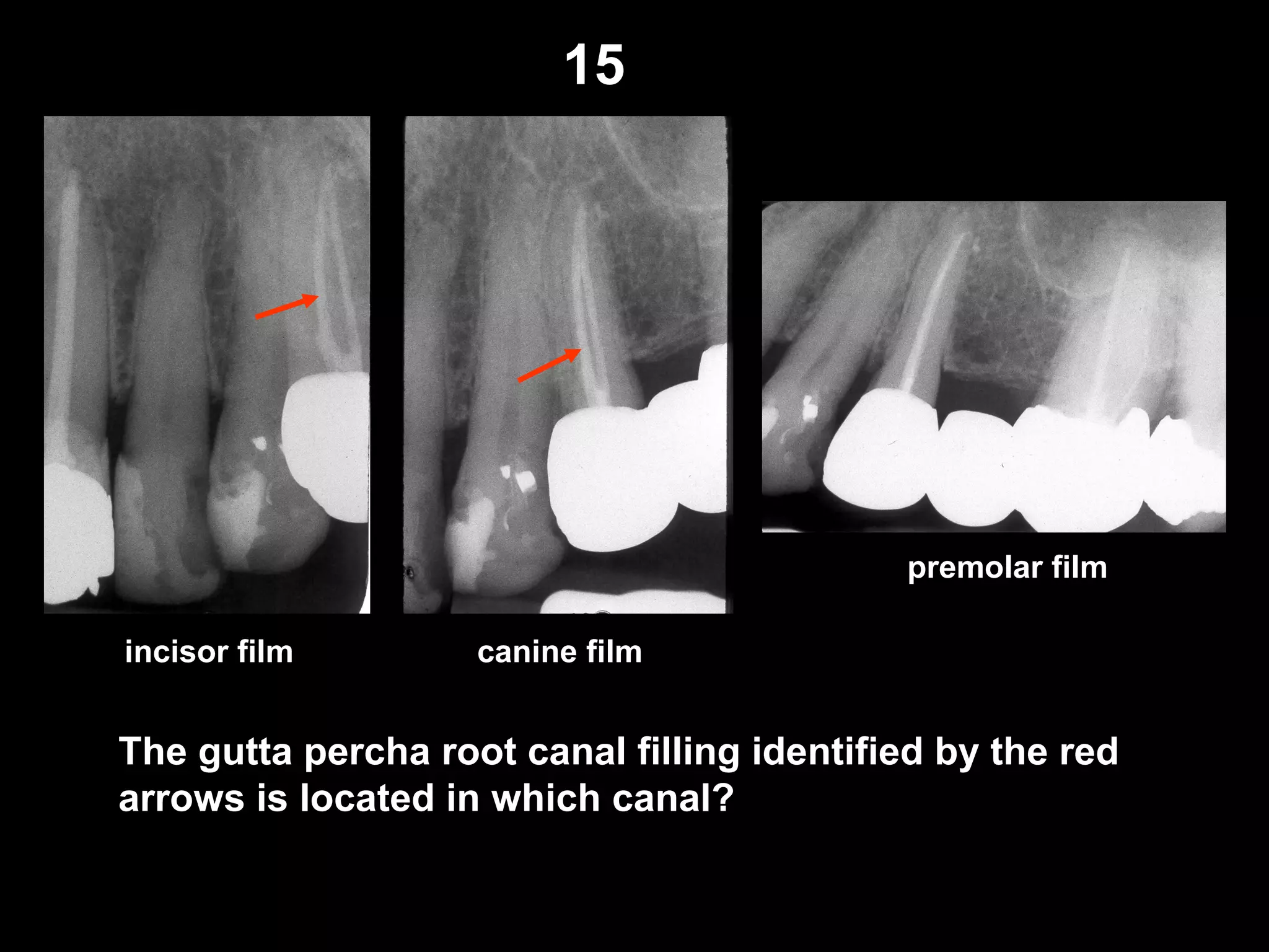 15
incisor film canine film
premolar film
The gutta percha root canal filling identified by the red
arrows is located in which canal?
 