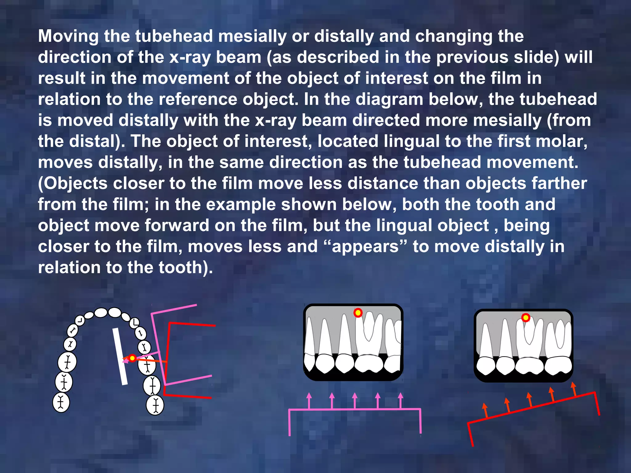 Moving the tubehead mesially or distally and changing the
direction of the x-ray beam (as described in the previous slide) will
result in the movement of the object of interest on the film in
relation to the reference object. In the diagram below, the tubehead
is moved distally with the x-ray beam directed more mesially (from
the distal). The object of interest, located lingual to the first molar,
moves distally, in the same direction as the tubehead movement.
(Objects closer to the film move less distance than objects farther
from the film; in the example shown below, both the tooth and
object move forward on the film, but the lingual object , being
closer to the film, moves less and “appears” to move distally in
relation to the tooth).
 