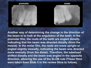 Messially Angulated Buccal Object Rule | PPT