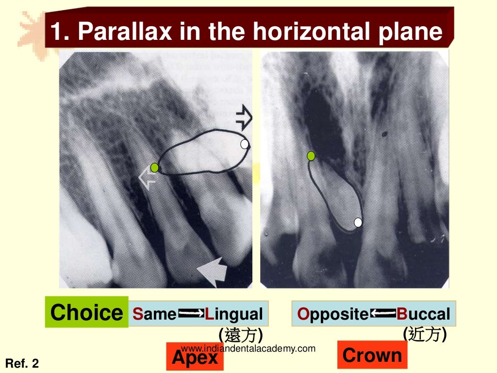 Buccal object rule/ dental implant courses