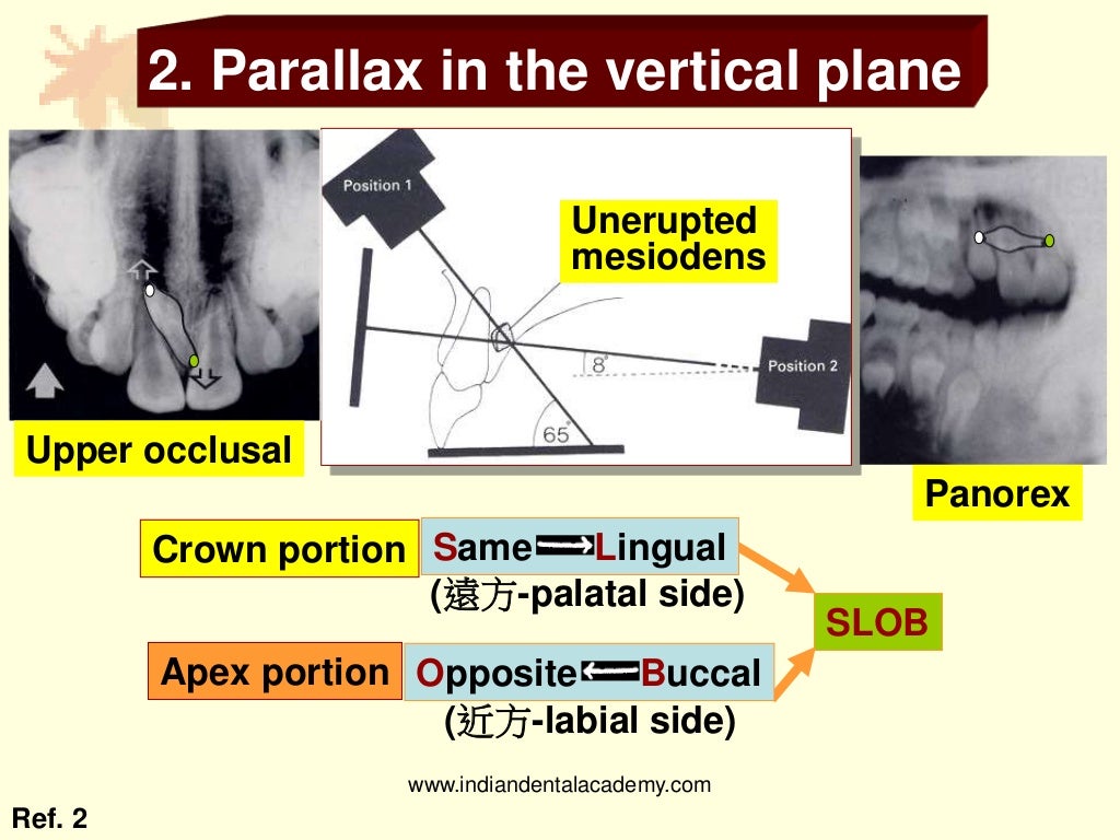 Buccal object rule/ dental implant courses