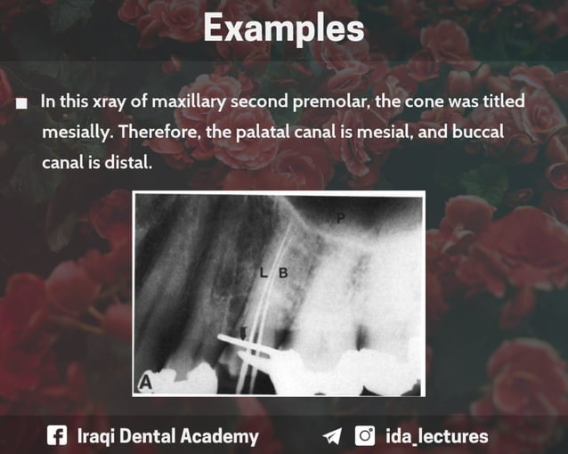 Buccal Object Rule A Radiographic Aid in Dental Practice.