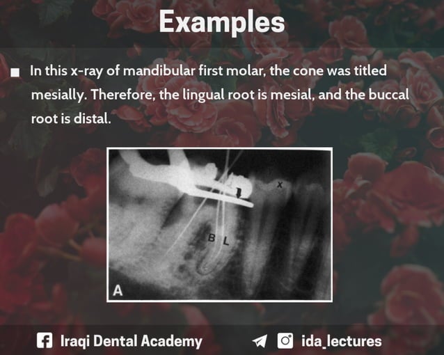 Buccal Object Rule A Radiographic Aid in Dental Practice.