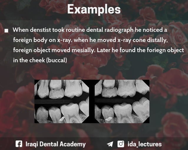 Buccal Object Rule A Radiographic Aid in Dental Practice.