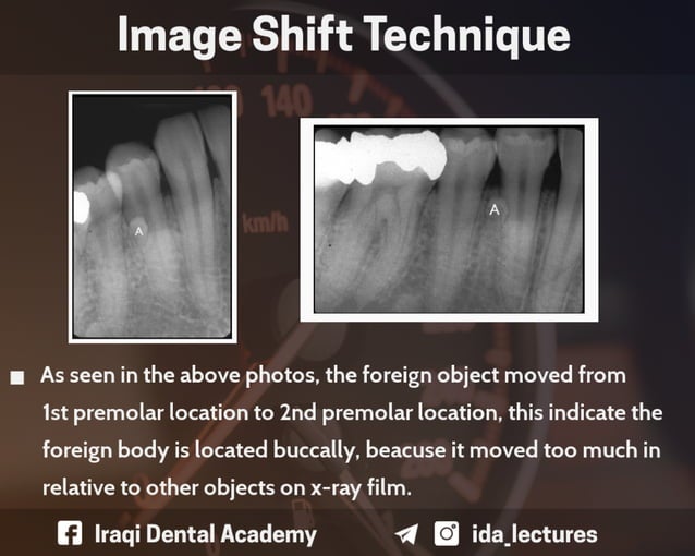 Buccal Object Rule A Radiographic Aid in Dental Practice.