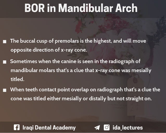 Buccal Object Rule A Radiographic Aid in Dental Practice.