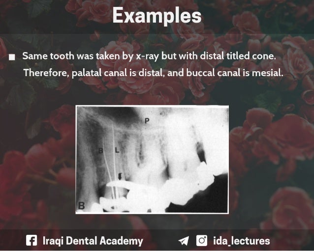 Buccal Object Rule A Radiographic Aid in Dental Practice.