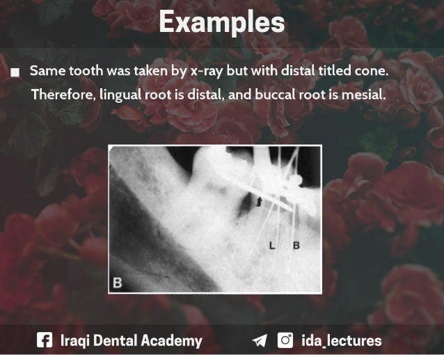 Buccal Object Rule A Radiographic Aid in Dental Practice.