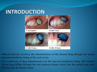Buccal delivery involves the administration of the desired drug through the buccal
mucosal membrane lining of the oral cavity.
It is a delivery of drug administered over the mucosal membrane lining (the cheeks)
where drug diffuse through the oral mucosa (tissues which line the mouth) and enter
directly into the blood stream.
 