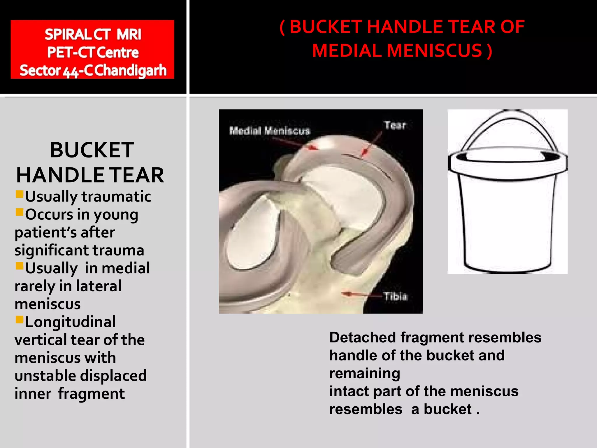 Bucket Handle Tear PPT