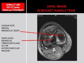 AXIAL IMAGE
                 IN BUCKET HANDLE TEAR.



DONOR SITE
MEDIAL
MENISCUS BODY


DISPLACED
MENISCAL
FIBROCARTILAGE
IN THE
INTERCONDYLAR
REGION.
 