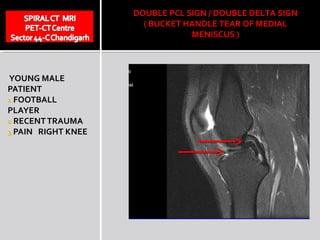 DOUBLE PCL SIGN / DOUBLE DELTA SIGN
                      ( BUCKET HANDLE TEAR OF MEDIAL
                                MENISCUS )



YOUNG MALE
PATIENT
1.FOOTBALL
PLAYER
2.RECENT TRAUMA
3.PAIN RIGHT KNEE
 