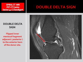 DOUBLE DELTA SIGN


DOUBLE DELTA
   SIGN

    Flipped inner
 meniscal fragment
adjacent ( posterior )
to the anterior horn
 of the donor site.
 